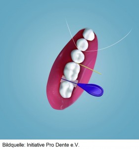 Im Mund gibt es schwer erreichbarer Stellen. Die Rede ist von Zahnzwischenräumen und Zahnfleischtaschen. Die Zahnbürste reinigt nur etwa 70 Prozent der Zahnoberfläche, der Rest liegt im Verborgenen.