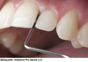 Seit 2004 übernehmen die Kassen alle zwei Jahre die Kosten für einen speziellen Parodontitis-Test. Während des Tests tastet der Zahnarzt mit einer Sonde das Gewebe zwischen Zähnen und Zahnfleisch ab. Er misst die Tiefe der Zahnfleischtaschen und prüft ob eventuell eine Entzündung vorliegt. In schweren Fällen wird der betroffene Kiefer geröntgt, so dass der Zahnarzt sich ein genaues Bild vom Zustand des Kieferknochens machen kann.